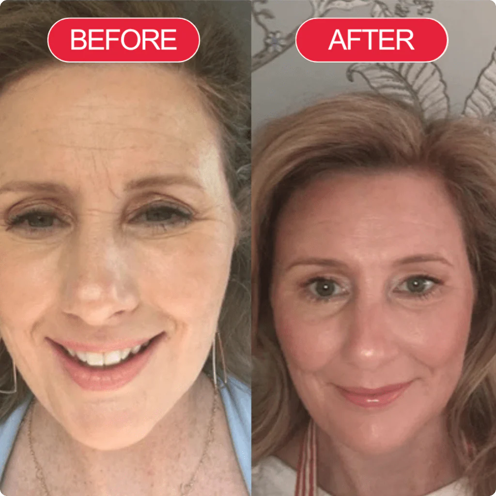 Lisa before and after using TECA Skin Repair Cream